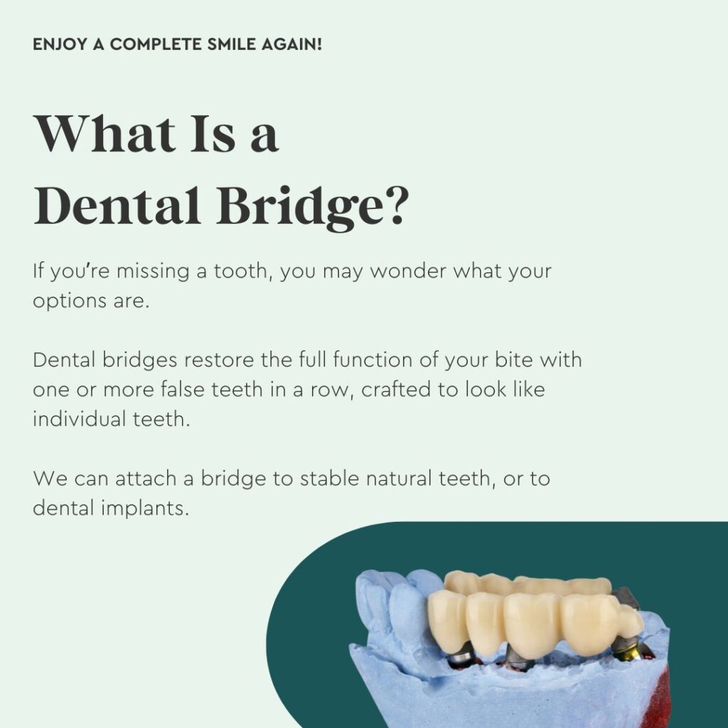 Photo shows an example of a dental bridge and explains how we can replace missing teeth with dental bridges in Forestville.